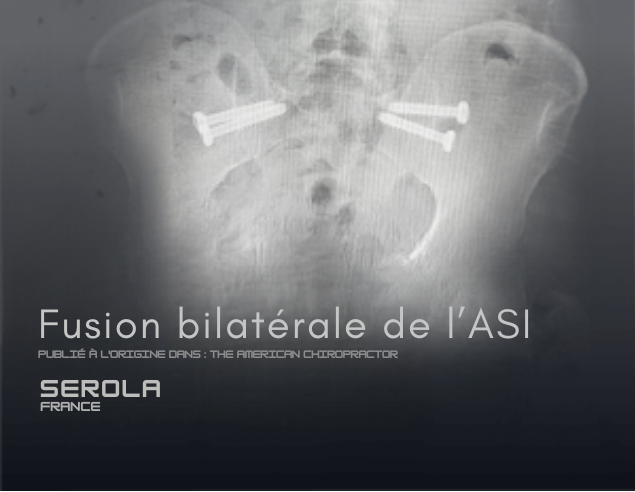 SCREWED Fusion Bilat Originally Published in THE AMERICAN CHIROPRACTOR e1744382513649