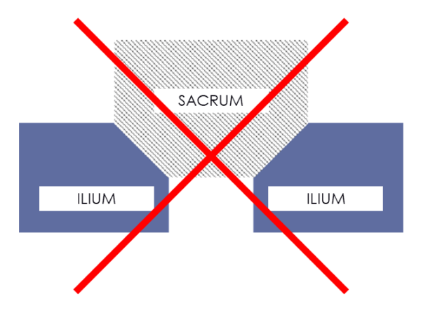 Le Paradoxe du sacrum : Stabilité ou Suspension ? 2 Sacrum Wedged Crossed Out